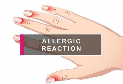 How to treat an allergic reaction to gel nail polish?